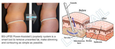 Vücut Şekillendirme Bakımları İçin Vücut Şekillendirme Gücü Destekli Liposuction Ekipmanları